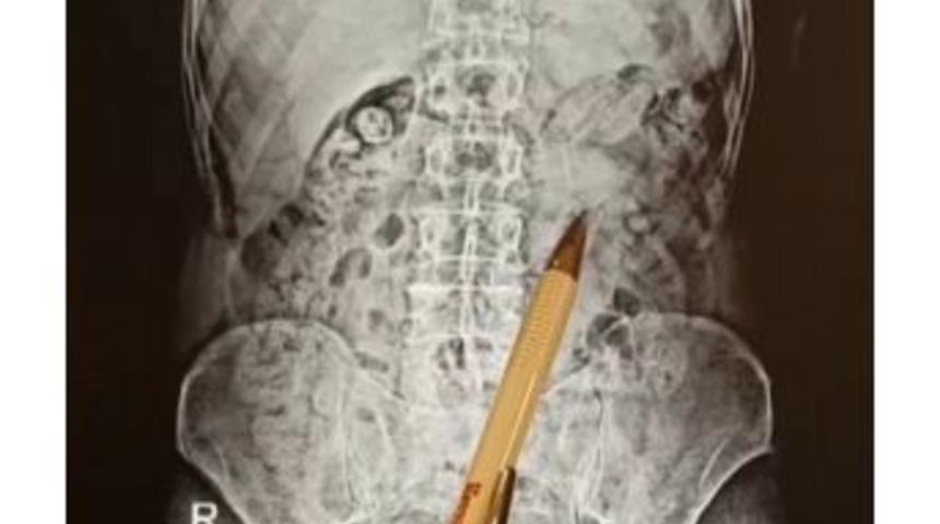 Mide Ve Bağırsaklarına Uyuşturucu Saklamışlar