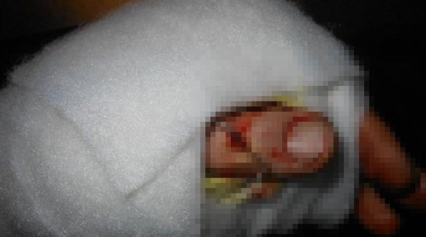 Parmak Kopmasında İlk Yapılması Gerekenler