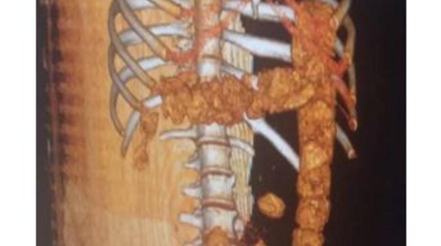 Midesinden 1 Kilo 350 Gram Uyuşturucu Madde Çıktı