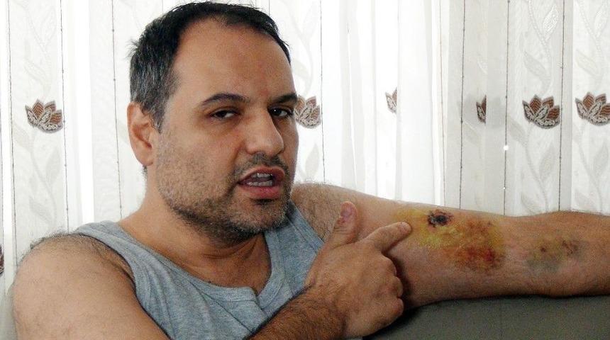 Antalya&rsquo;da Tartıştığı Hasta Bakıcı Tarafından Kolundan Isırılan Vatandaş Hastanelik Oldu