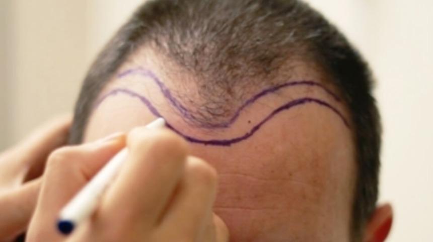 Saç ekimi sonrası pişmanlığa son! Kötü saç ekimi nasıl düzeltilir?