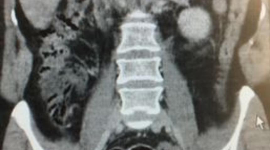 Rus Uyruklu Kadının Midesinden 7 Paket Uyuşturucu &Ccedil;ıktı