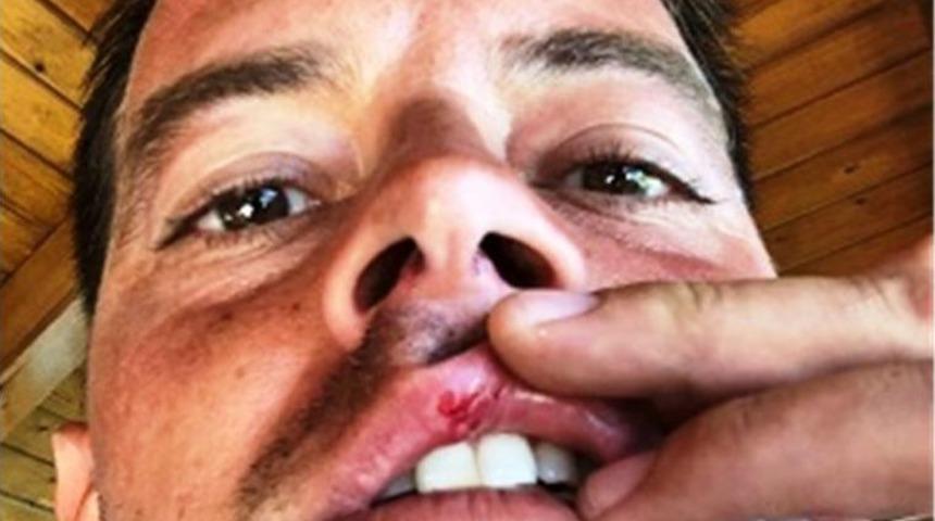 Alp Kırşan Tatilde Motosikletiyle Kaza Yaptı