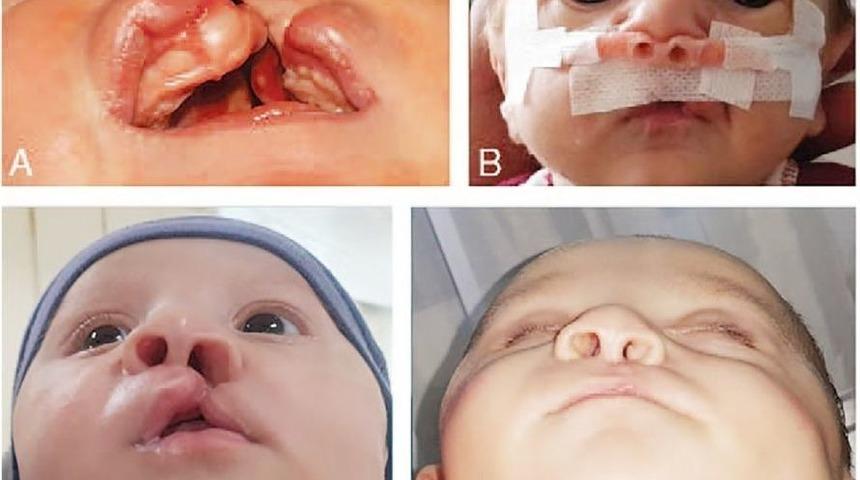 Diş Hekimliği Fak&uuml;ltesinde Yarık Damak Dudak Tedavilerine Başlandı