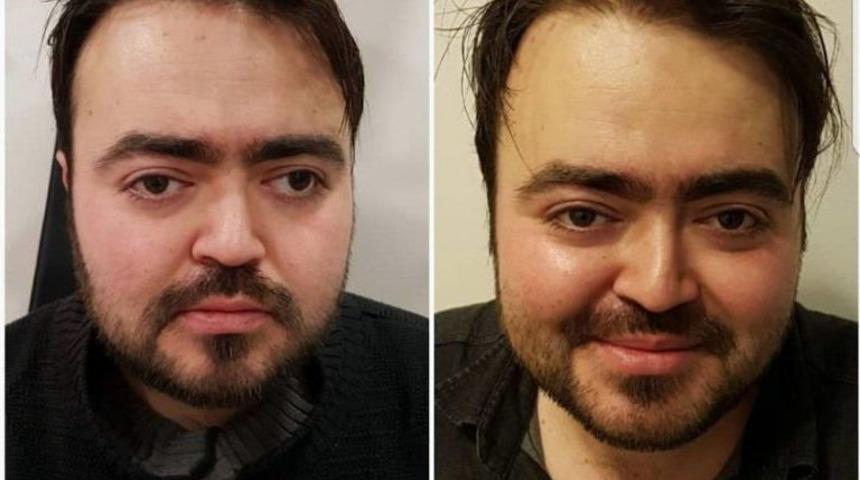 Sevgilisinin G&ouml;zlerine Bakabilmek İ&ccedil;in Ameliyat Oldu