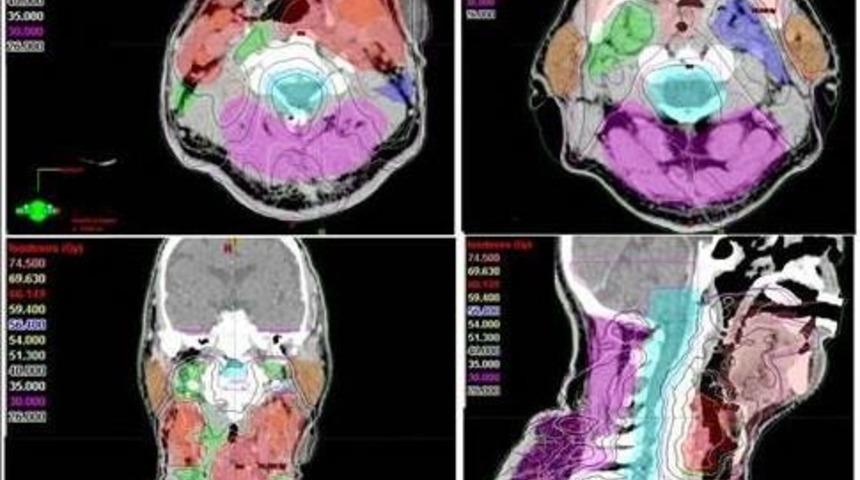Kanser Tedavisinde &rsquo;yapay Zeka&rsquo; Başarısı