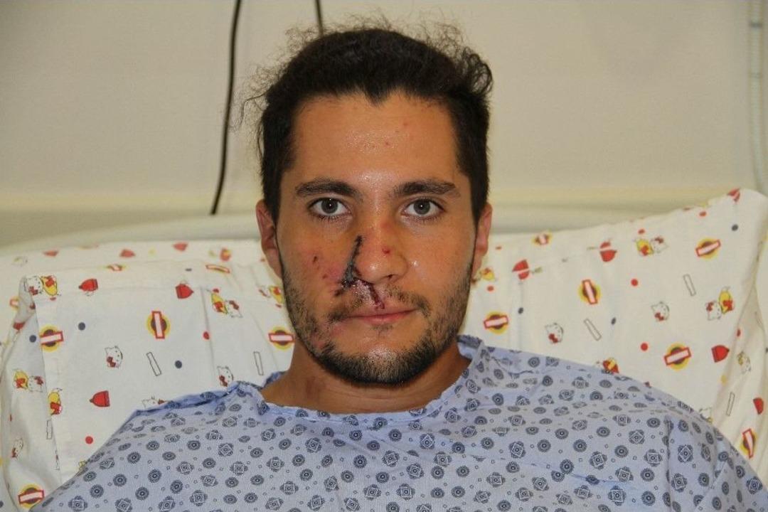 Alanya&rsquo;da Kazada Burnu Kopan Rus Gence Kulağından Alınan Doku İle Burun Yapıldı