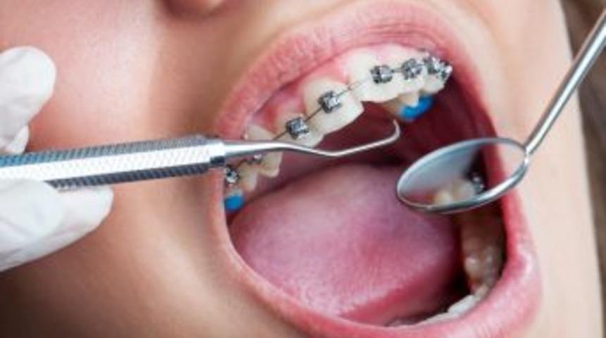 Ortodontik Tedavi &Ouml;ncesi Dişeti Muayenesi Şart