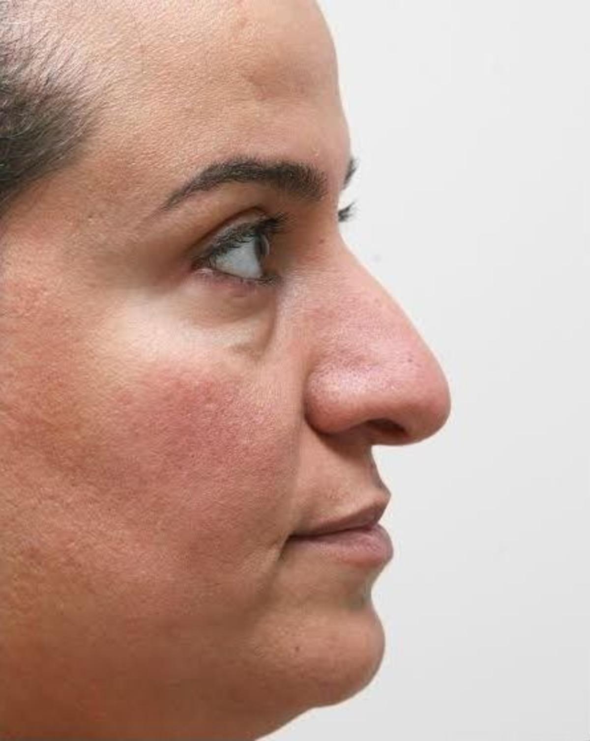 "&ouml;ğle Arası" Burun Estetiği