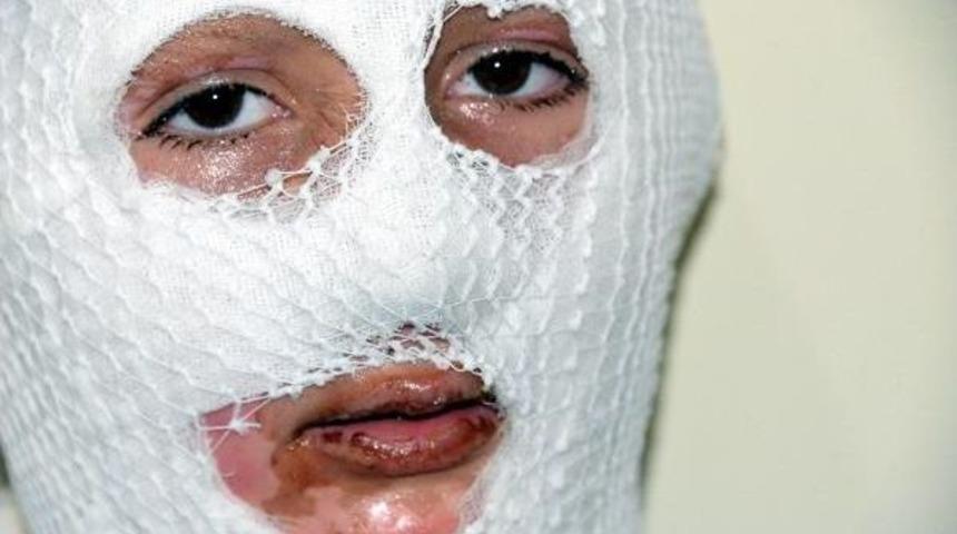 &Ccedil;&ouml;pte Patlayan Parf&uuml;m Vedat'ın Y&uuml;z&uuml;n&uuml; Yaktı