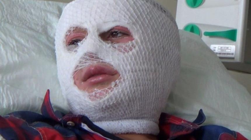 Patlayan Parf&uuml;m Şişesi Y&uuml;z&uuml;n&uuml; Yaktı