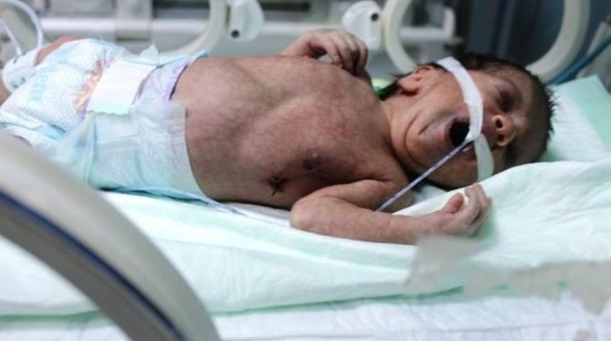 (özel Haber) 7 Aylık Bebeğe Ameliyat