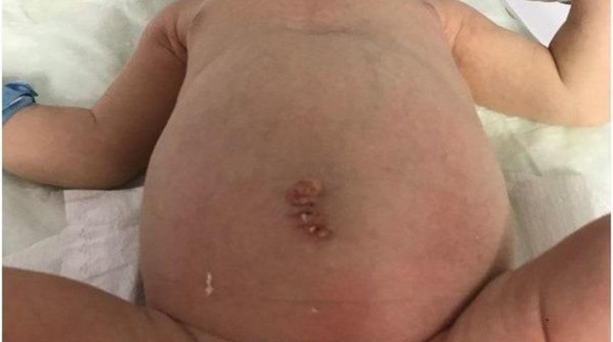 Yenidoğan Bebeğe &rsquo;omfalosel&rsquo; Ameliyatı Yapıldı