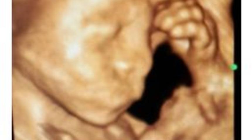 Anne Karnında D&uuml;ş&uuml;nen Bebek