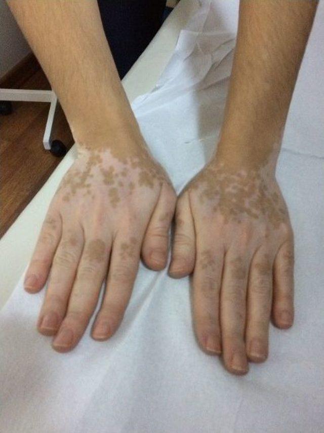 Vitiligo’da (ala Hastalığı) Yeni Bulgular, Hastalığın Tedavisinde Olumlu Sonuçlara Yolaçtı