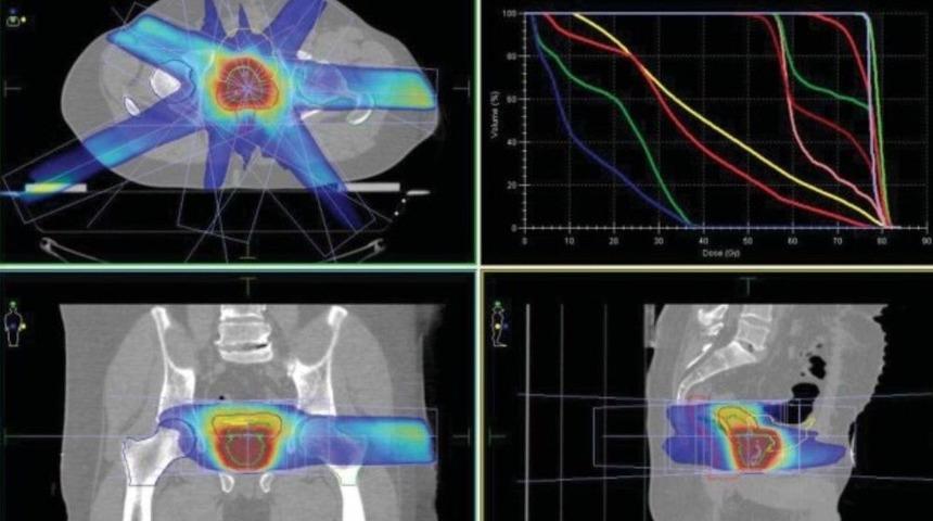 Prof. Dr. Yavuz: "prostat Kanserine Işınla Hızlı Tedavide Avantajlı Sonu&ccedil;lar Elde Edilebiliyor"