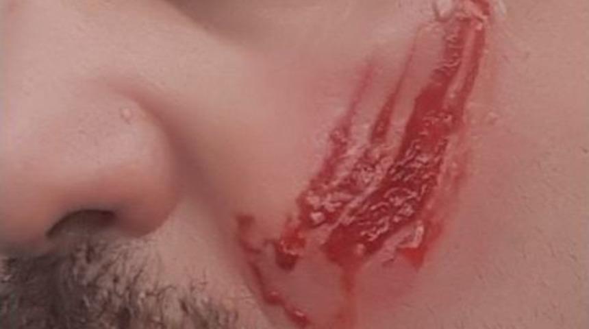 Borçlu İcra Takibi Yapan Avukatın Yanağını Isırarak Kopardı