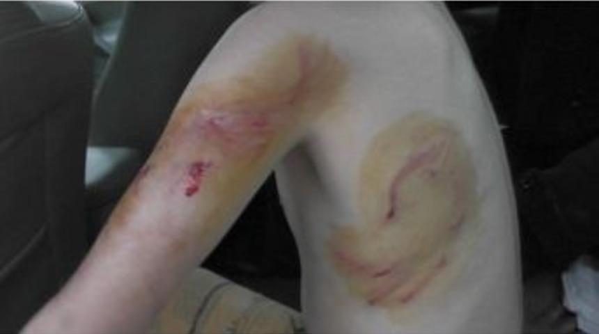 K&ouml;peğin Isırdığı &Ccedil;ocuk Hastanelik Oldu