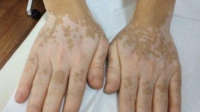 Vitiligo İle Baş Etmenin Yolu Güçlü Bağışıklık Sisteminden Geçiyor