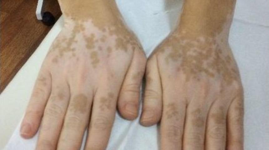 Vitiligo İle Baş Etmenin Yolu G&uuml;&ccedil;l&uuml; Bağışıklık Sisteminden Ge&ccedil;iyor