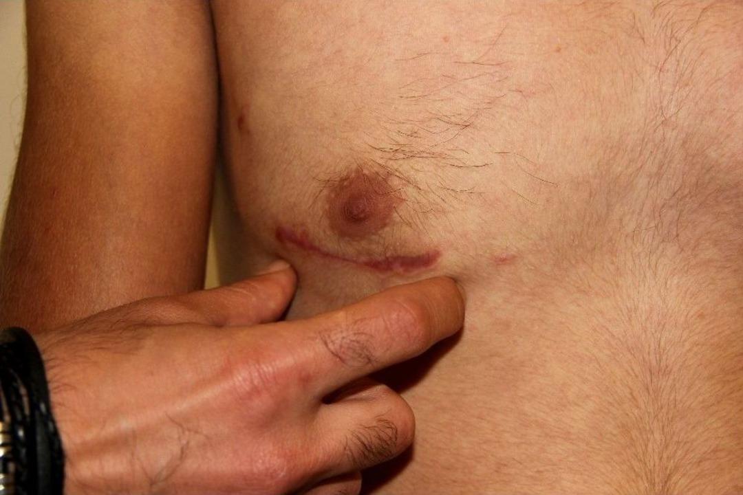 G&ouml;ğ&uuml;s Kafesi A&ccedil;ılmadan Delik Kalbi Ameliyat Edildi