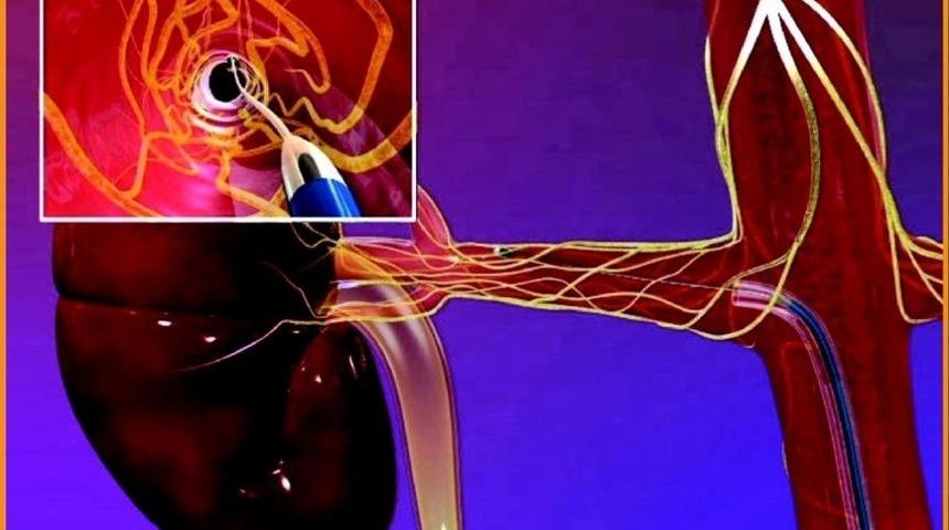 &ldquo;renal Denervasyon Tedavisi&rdquo; Hastalara Umut Oluyor
