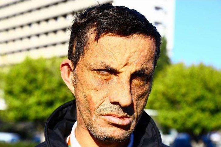 Yüz Nakilli Uğur Acar’ın Hedefi Üniversite Eğitimi G4