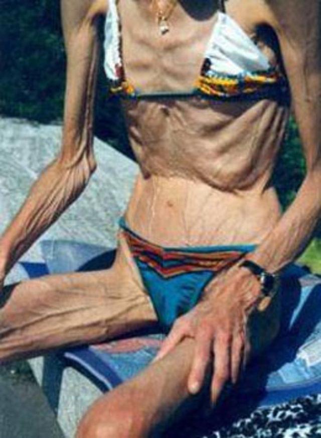 Anoreksiya kabusu 12