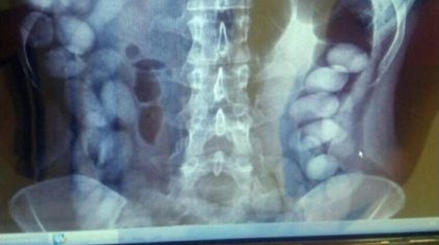 İ&ccedil; Organlarında 78 Adet Kokain Kaps&uuml;l&uuml;yle Yakalandı