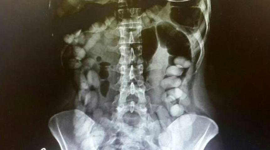 Venezuelalı Kadın Kurye, 78 Kokain Kaps&uuml;l&uuml;n&uuml; Yutmuş