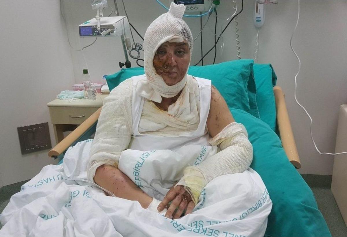 Tecav&uuml;z Etmek İstediği Azeri Kadını Kezzap İle Yaktı