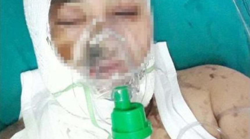 Azeri Kadın, Cinsel Saldırıya Uğrayıp Kezzapla Yakıldı