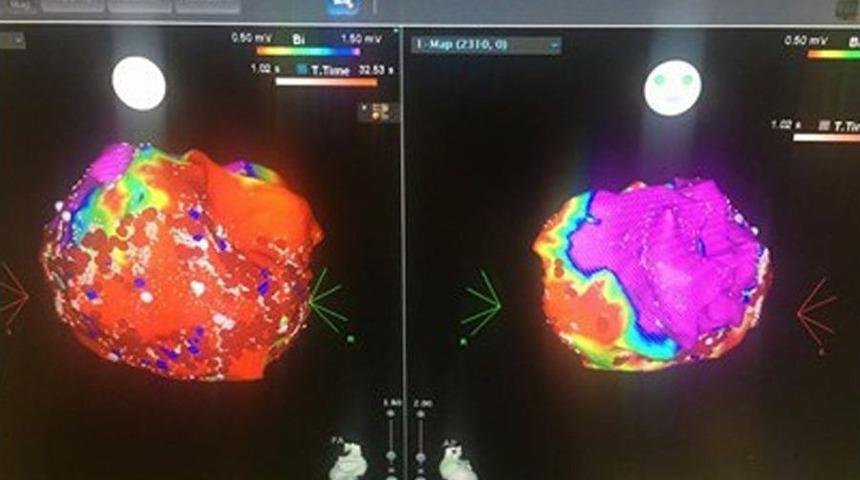 Kalp Ritim Bozukluklarında Yaşam Boyu İla&ccedil; Kullanımına Son!