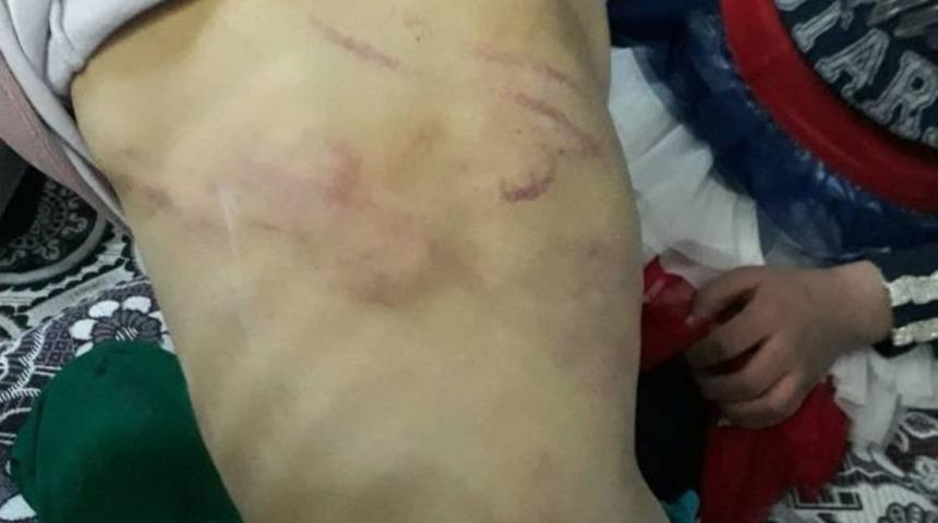 Suriyeli &Ccedil;ocuğun Babası Tarafından D&ouml;v&uuml;ld&uuml;ğ&uuml; Ortaya &Ccedil;ıktı