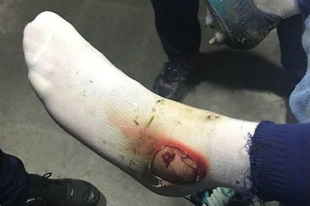 Fenerbah&ccedil;e Hasan Ali Kaldırım&rsquo;ın Ayağının Fotoğrafını Paylaştı.