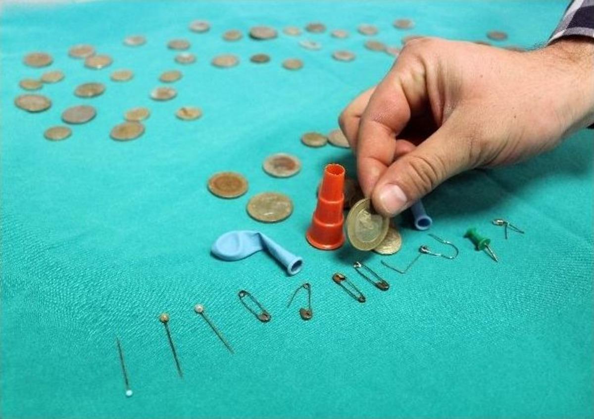 &Ccedil;ocukların Yemek Ve Soluk Borusundan &Ccedil;ıkanlar Hayrete D&uuml;ş&uuml;rd&uuml;