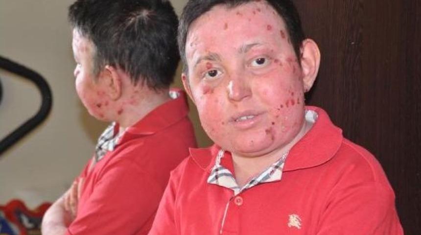 Emirhan, Kesin Tedavisi Olmayan Hastalıkla M&uuml;cadele Ediyor