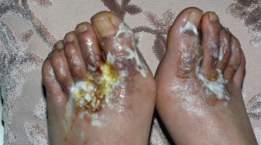 Erzurum&rsquo;da Bir Gen&ccedil; Kızın Giydiği Ayakkabılar Nedeniyle Hastanelik Olduğu &Ouml;ne S&uuml;r&uuml;ld&uuml;