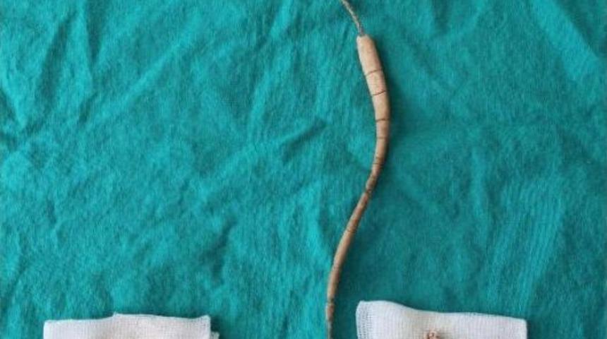 Korkup &Ccedil;ıkarttırmadığı Tel, 30 Santimetre Taş Oluşturdu