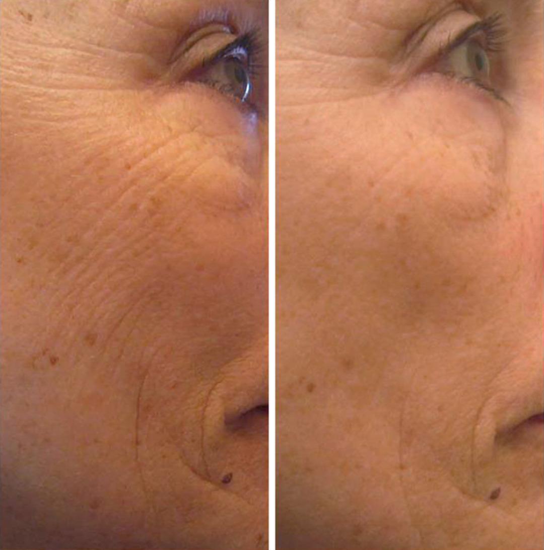 Cildinizin sağlık re&ccedil;etesi evinizde! Hem de hi&ccedil;bir kimyasal madde kullanmadan...