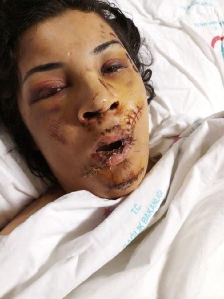 Eski Eşinin Yüzünü Şişeyle Parçaladı G4