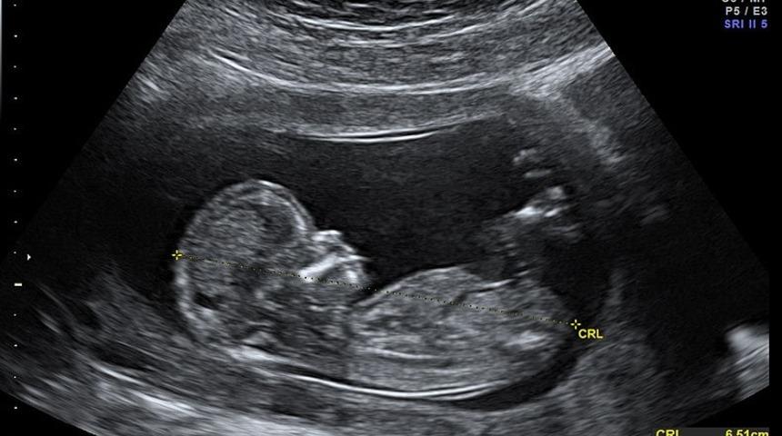 İngiltere'de bekar erkekler hedefte: Dolandırıcıların yeni y&ouml;ntemi ultrason fotoğrafları!