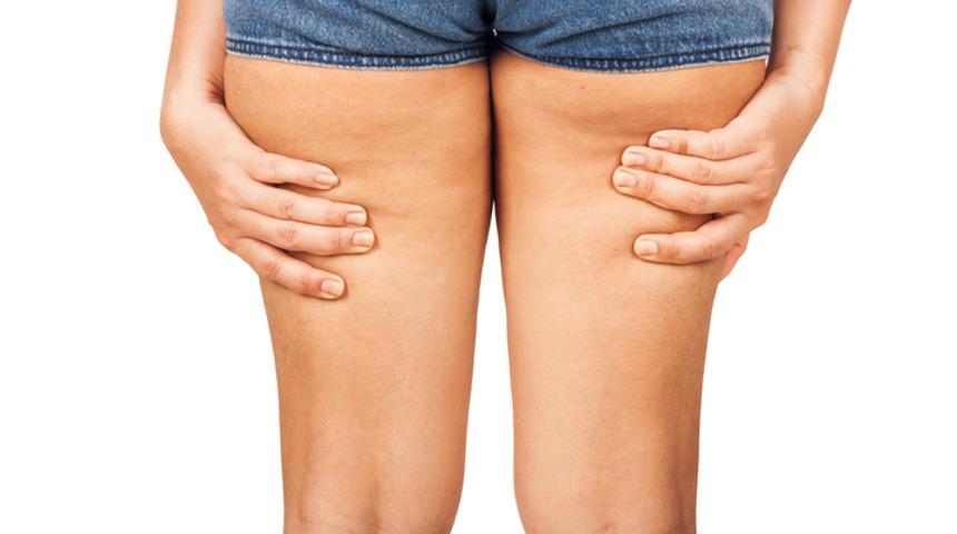 Kadınların kabusu sel&uuml;lit! 