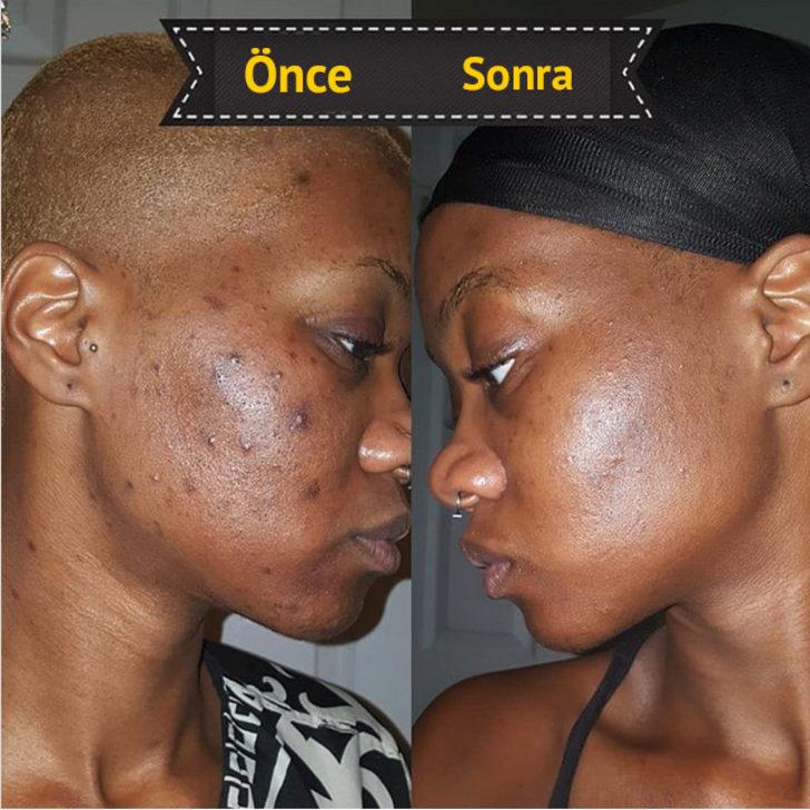 Kate Middleton kusursuz cildini buna borçlu! İşte kuşburnu yağı hakkında bilmedikleriniz G2