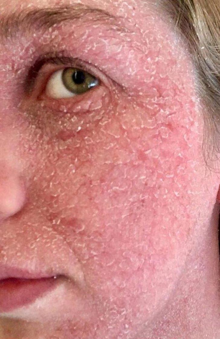 Egzema düğün zamanı kabusu oldu G5