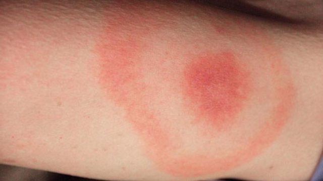 Lyme hastalığı tedavi edilebilir mi? Lyme hastalığı tedavisi nasıl olur? Lyme hastalığı belirtileri nelerdir? Lyme hastalığı teşhisi