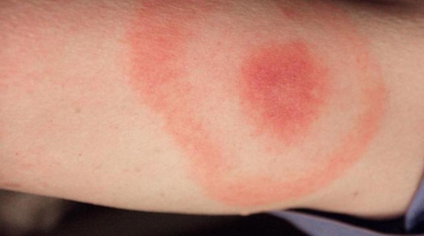 Lyme hastalığı tedavi edilebilir mi? Lyme hastalığı tedavisi nasıl olur? Lyme hastalığı belirtileri nelerdir? Lyme hastalığı teşhisi