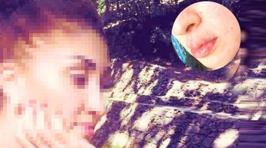 Dolgu dudak alarmı! İzmir İl Sağlık Müdürlüğü harekete geçti