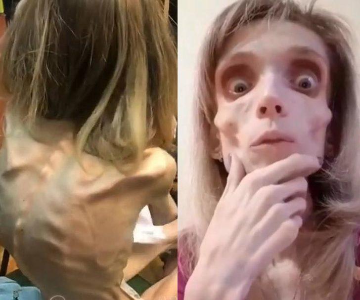 Anoreksiya hastası kadın sadece 17 kilo! G1
