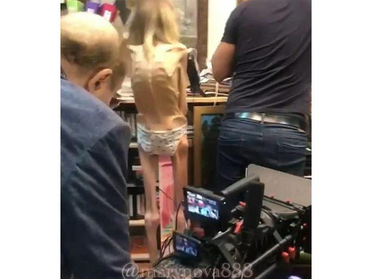 Anoreksiya hastası kadın sadece 17 kilo! G4